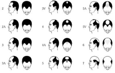 The Norwood Scale