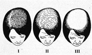 Ludwig Classification of Female Pattern Baldness